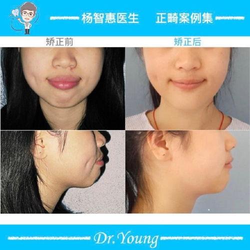 成人凸嘴矫正视频大全,成人凸嘴矫正视频大全精选攻略-第3张图片-丝瓜视频成人