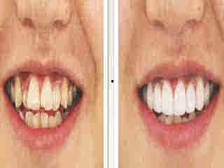 成人门牙后移矫正视频,跟随视频学习矫正过程-第1张图片-丝瓜视频成人