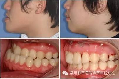 成人门牙后移矫正视频,跟随视频学习矫正过程-第2张图片-丝瓜视频成人