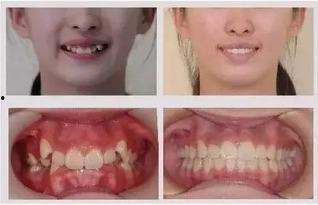 成人门牙后移矫正视频,跟随视频学习矫正过程-第3张图片-丝瓜视频成人